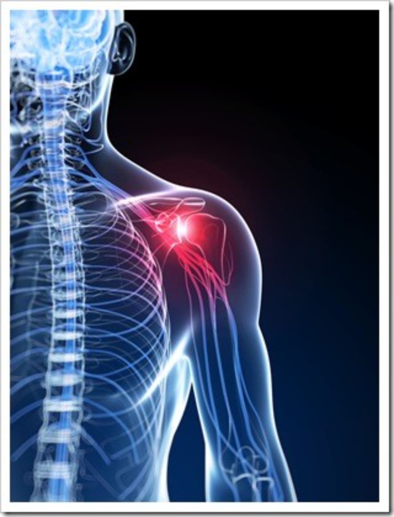 Frozen Shoulder Manchester IA Neck Pain