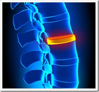 Herniated Disc and Back Pain Manchester IA